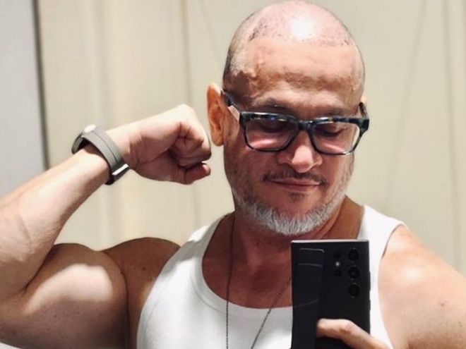 Щоб не облисіти, як батько: Ектор Хіменес-Браво зважився на операцію з пересадки волосся