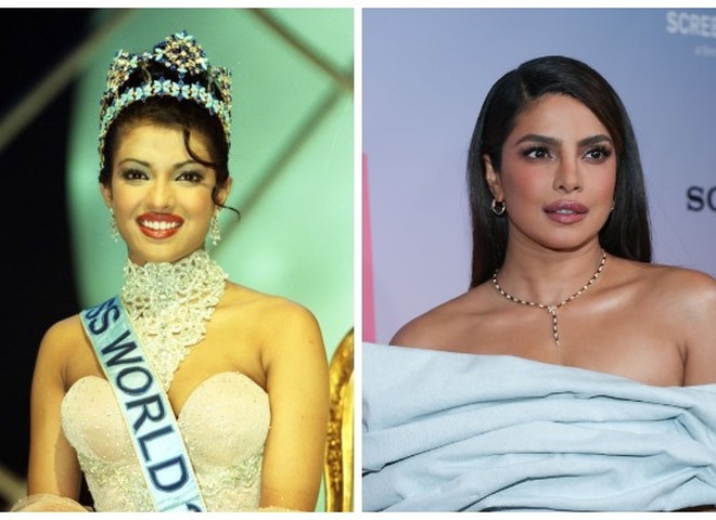 Приянка Чопра розповіла про наслідки невдалої операції на носі