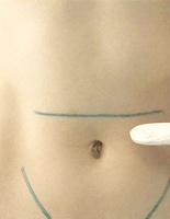 Пластична хірургія