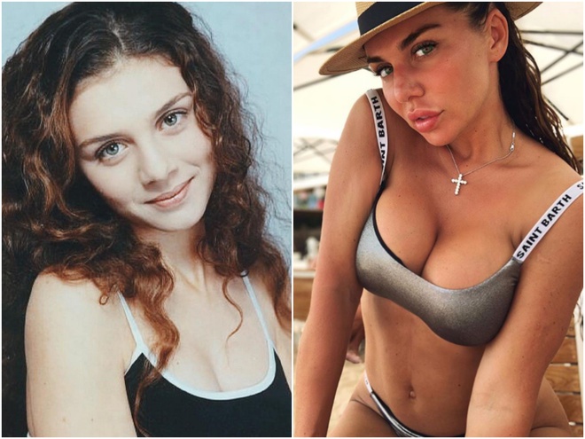 Анна Сєдокова до і після пластичних операцій