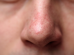 Демодекоз або підшкірний кліщ