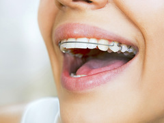Сколько носить брекеты для получения идеальной улыбки?
