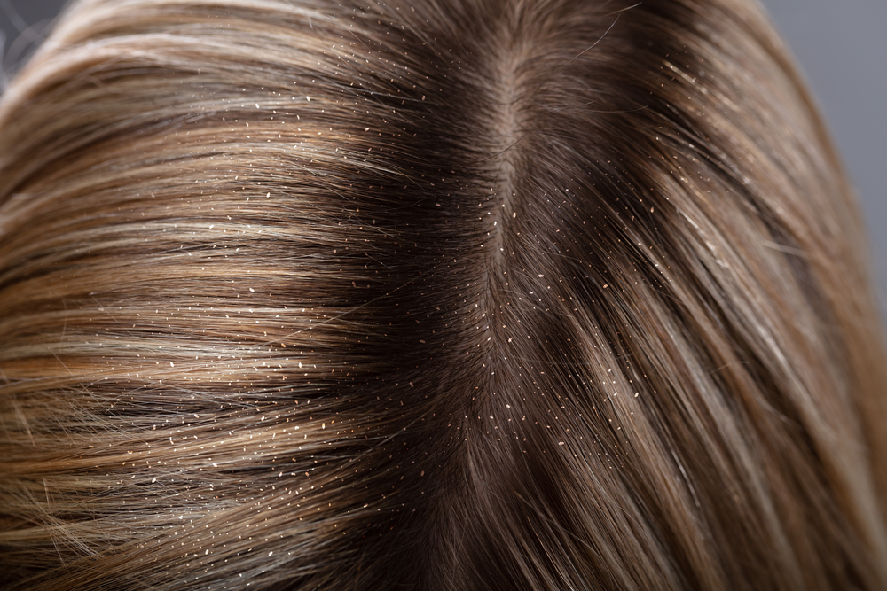 Вызывает ли перхоть выпадение волос?